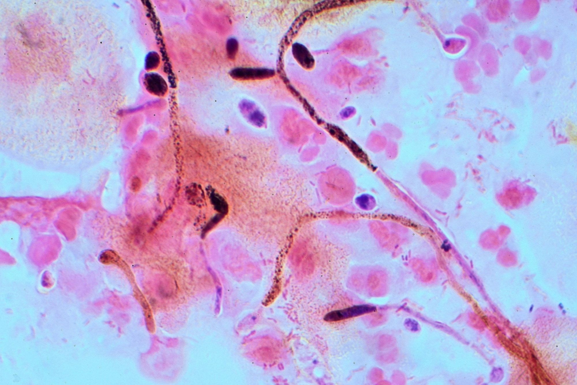 Candida pada Gram stain (contoh)